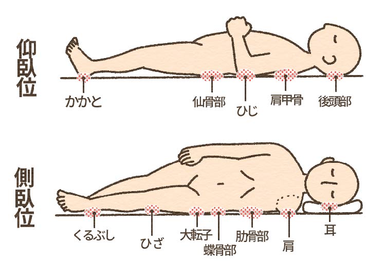 床ずれのイラスト